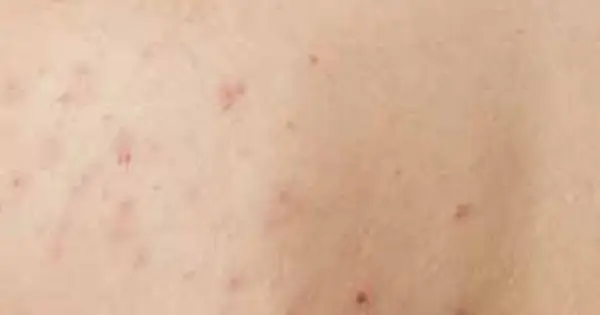 6 quick easy tips to get rid of back acne