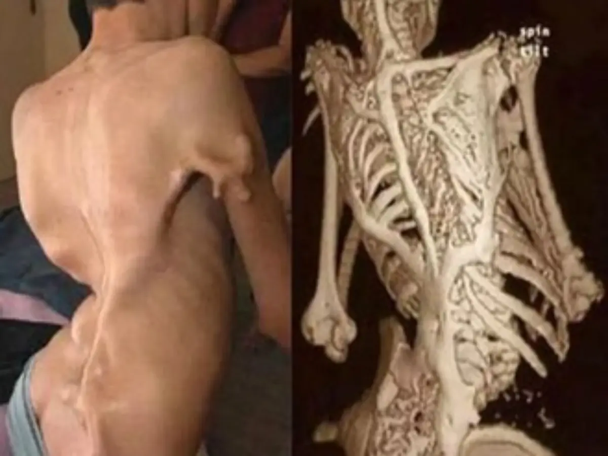 जैसलमेर में स्टोन मैन सिंड्रोम की दस्तक, 9 साल के बच्चे की मांसपेशियां धीरे-धीरे बन रही हड्डी, राजस्थान में पहला केस डिटेक्ट